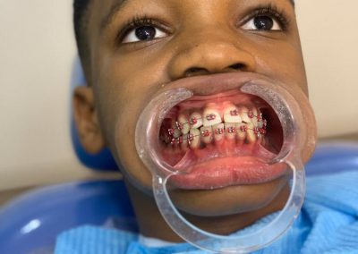 Deluxe Dental - Scaling & Polishing